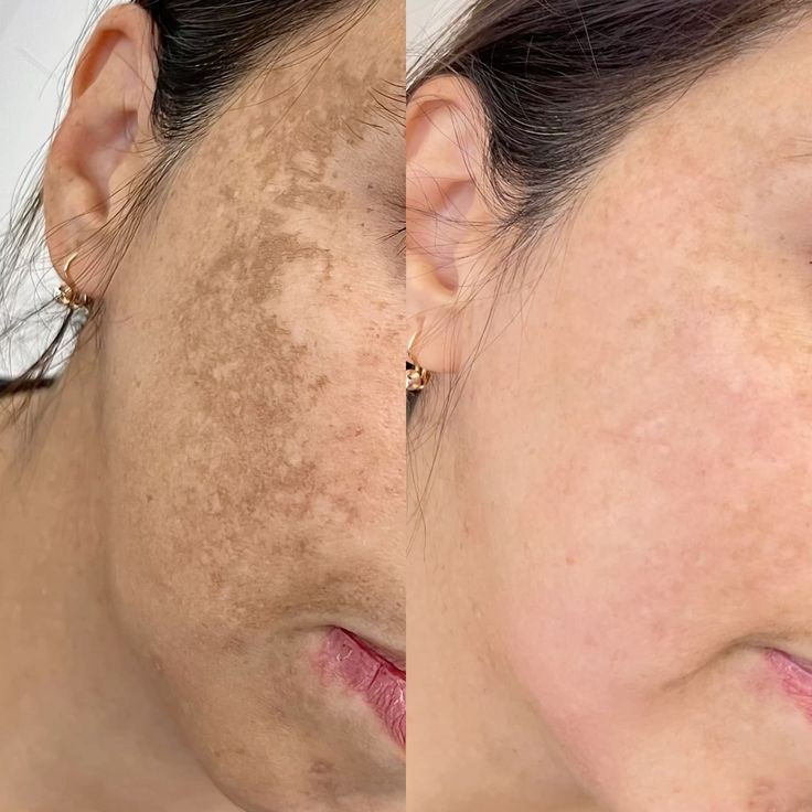 Anti-Melasma Night Cream-20ml