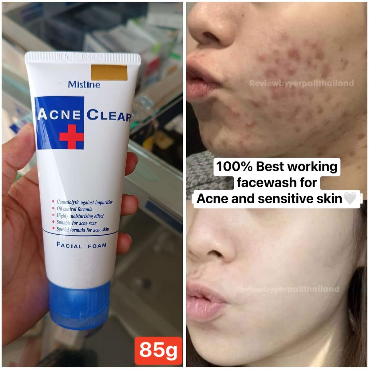 Acne Clear Facewash-85g