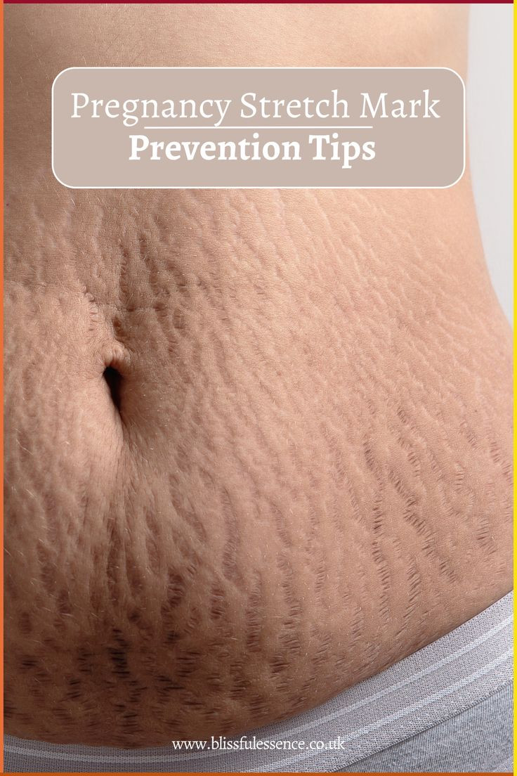 Aichun Beauty Anti-Stretch Mark Cream (60g) - Intensive Skin Treatment for Pregnancy & Weight Loss
