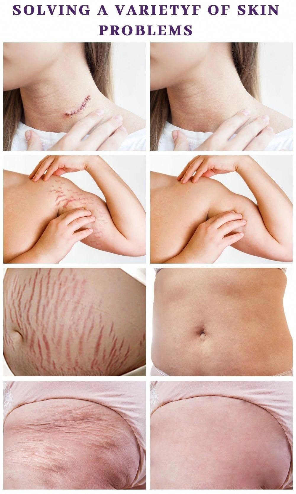 Aichun Beauty Anti-Stretch Mark Cream (60g) - Intensive Skin Treatment for Pregnancy & Weight Loss