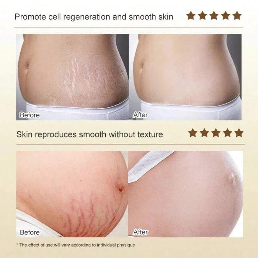 Laoshiya Anti-Stretch Mark Cream - Advanced Skin Treatment (63g)